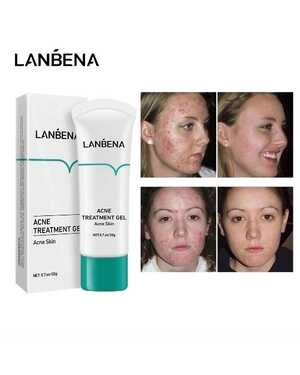 гель для лечения прыщей, контроль жирности